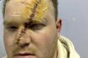 Scarred for life: Dean Brooks was slashed across the face as he walked through Sutton town centre