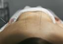 A GinSen client having acupuncture treatment on their back