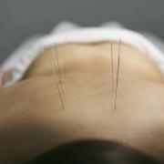 A GinSen client having acupuncture treatment on their back